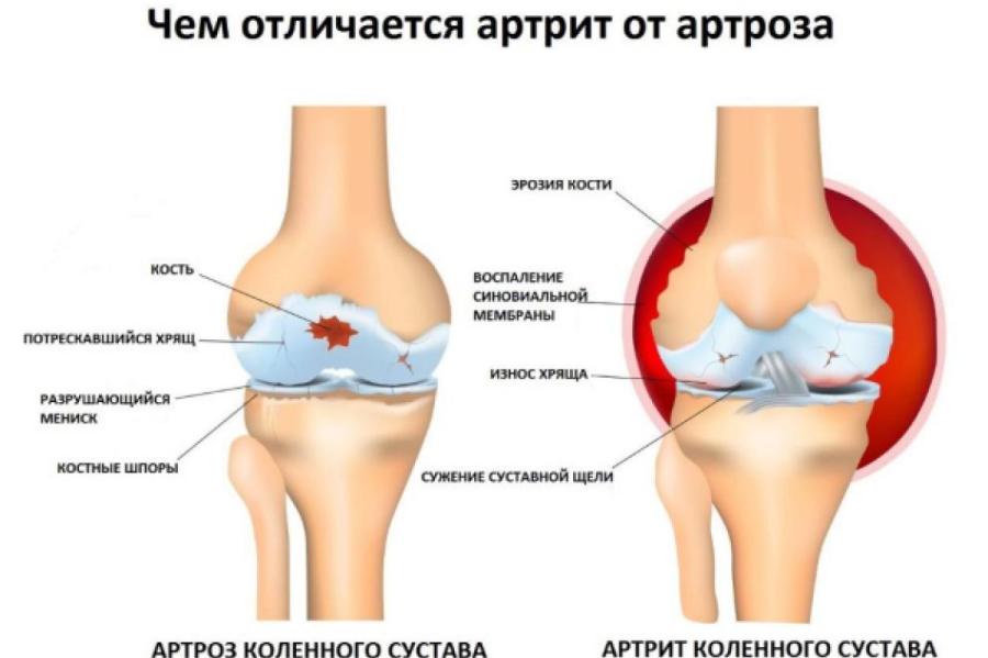 Большая разница: чем отличаются артроз, артрит и остеопороз