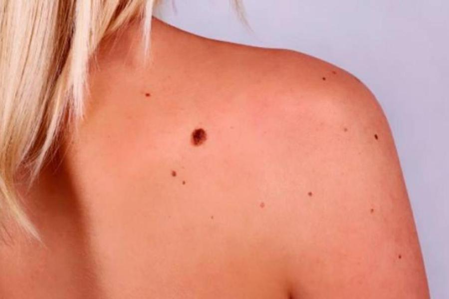 Родинки: удалять нельзя оставить