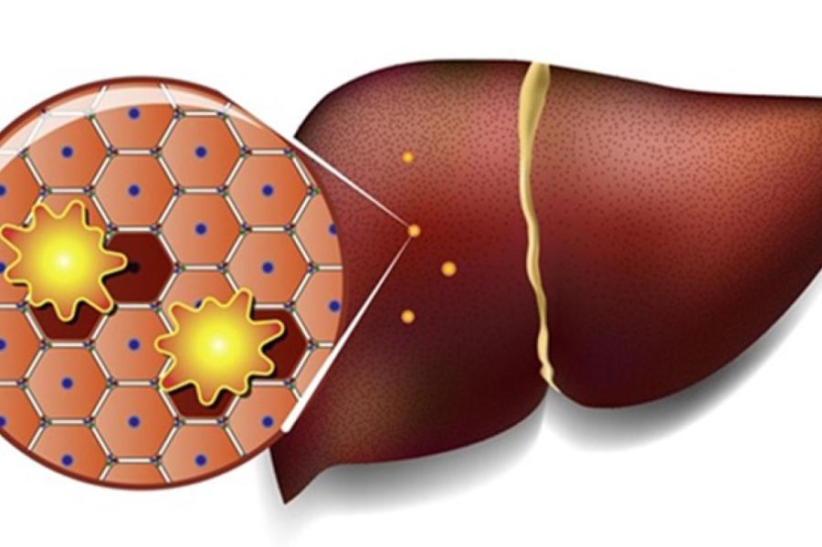Как избежать жирового гепатоза: три проверенные стратегии