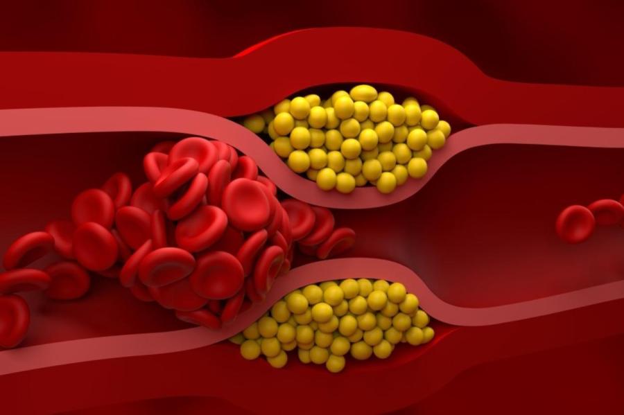 Высокий холестерин: грозит ли он худым людям