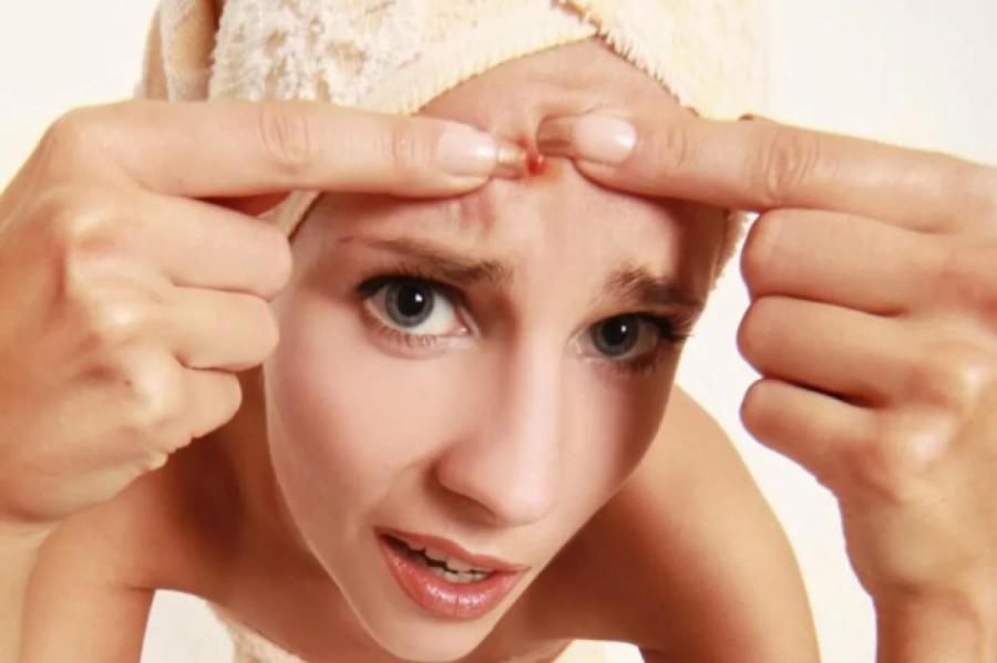 Врач-дерматолог объяснил, почему нельзя «давить» прыщи самостоятельно