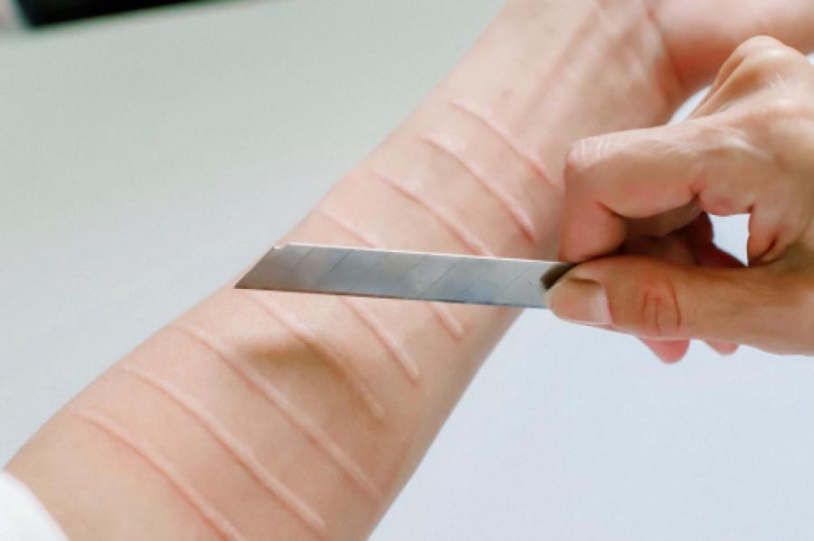 Селфхарм: зачем люди делают себе больно, и чем это опасно