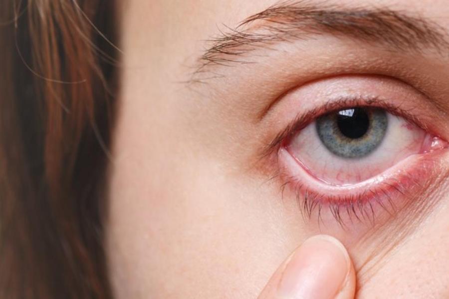 Пора к врачу? Почему лопаются сосуды в глазах