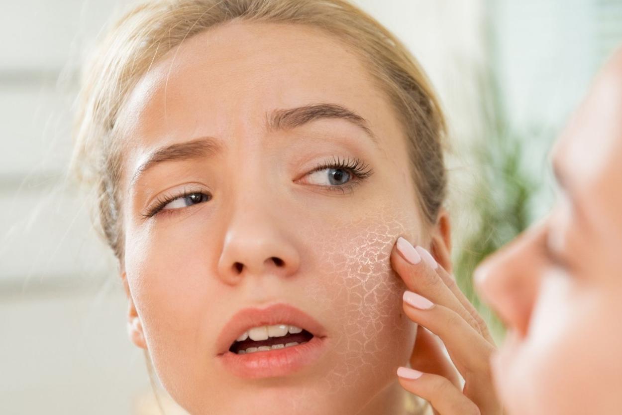 SOS-сигнал организма: как справиться с шелушением кожи в холодное время года