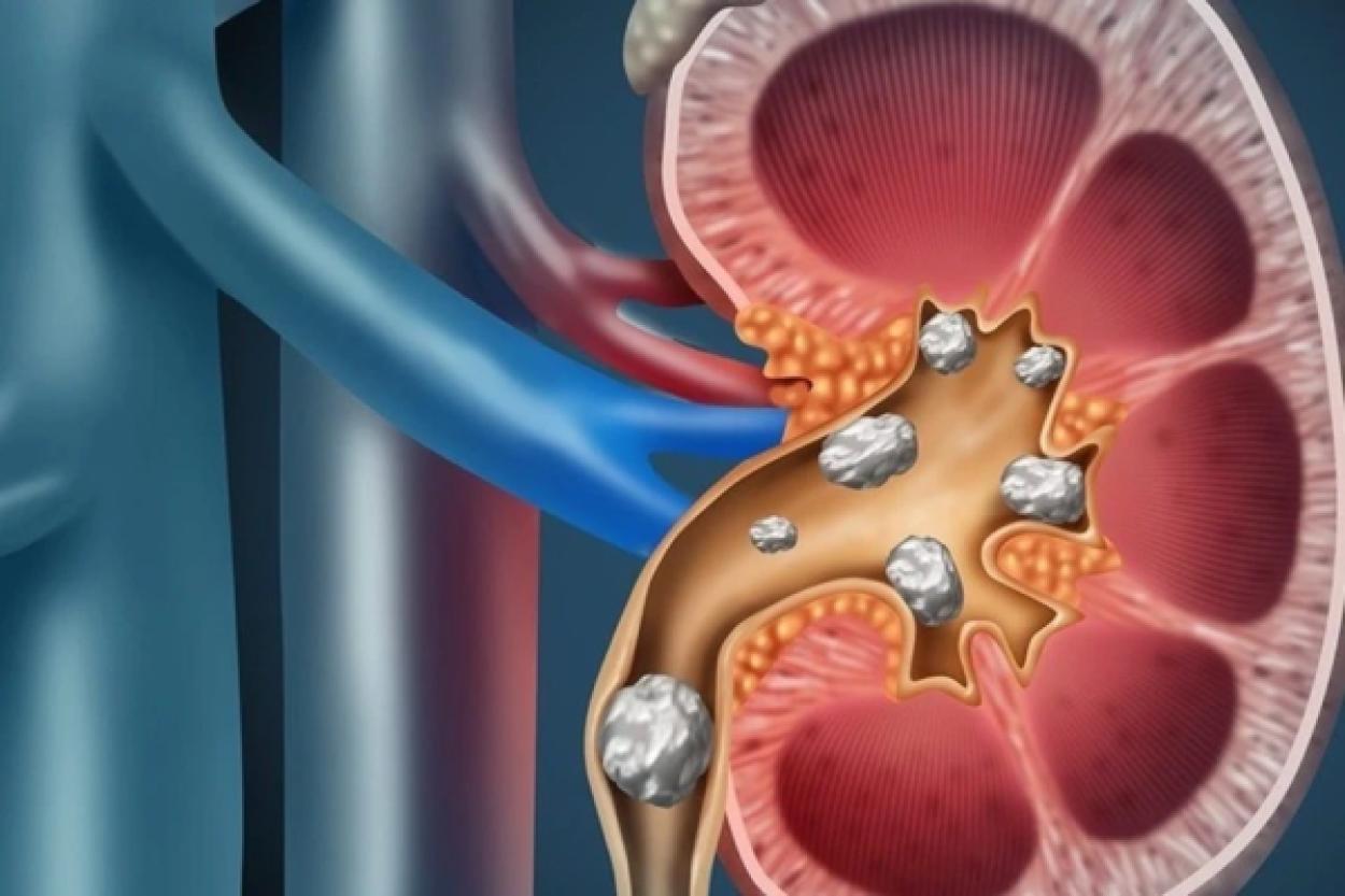 Как избежать мочекаменной болезни: советы по питанию