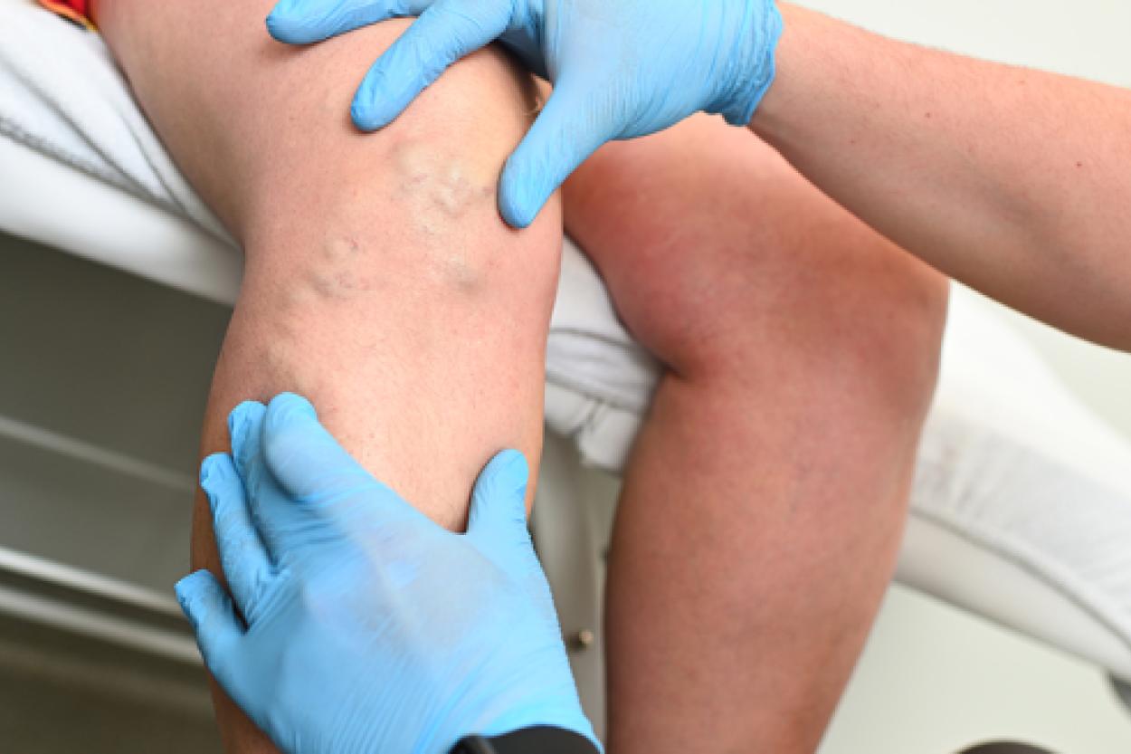 Как укрепить вены: советы от флеболога