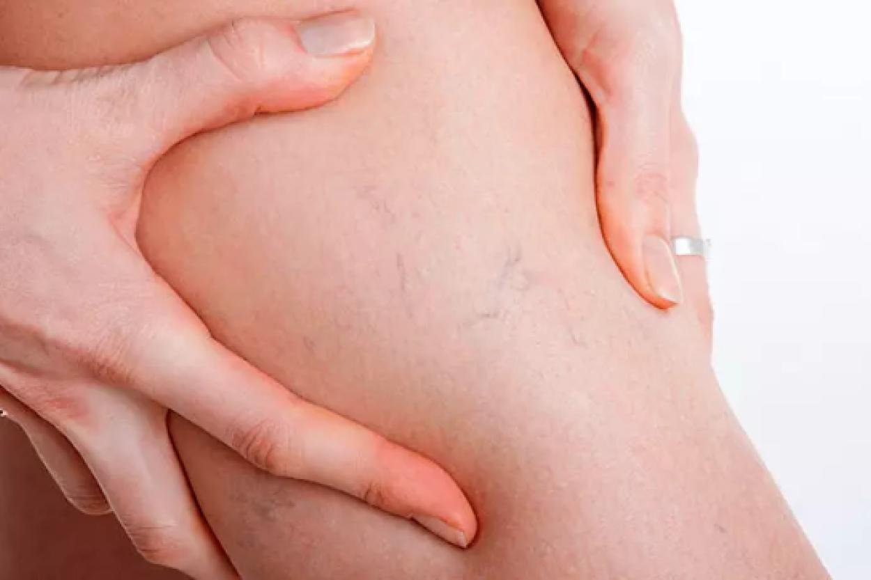 Когда вены на ногах становятся заметными: важные моменты, которые стоит обсудить с врачом