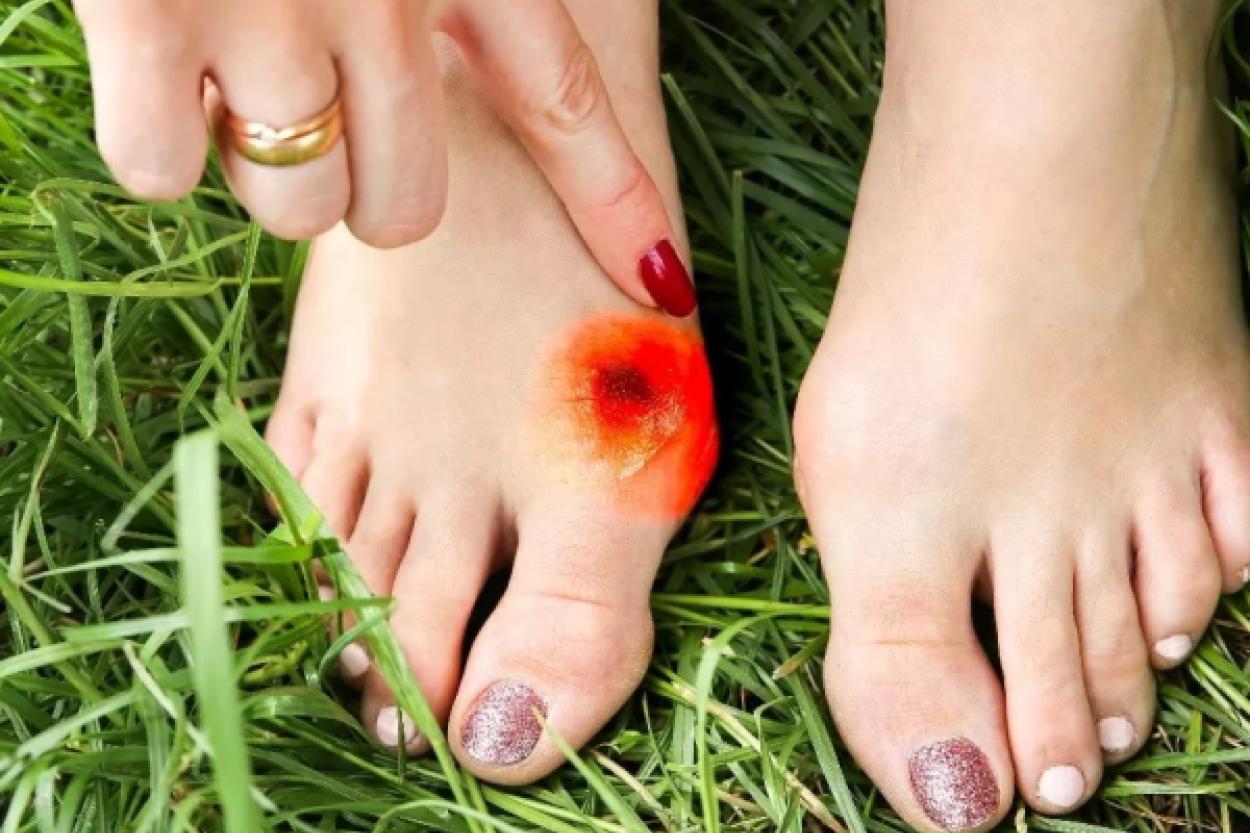 Косточка на стопе: когда операция становится необходимой