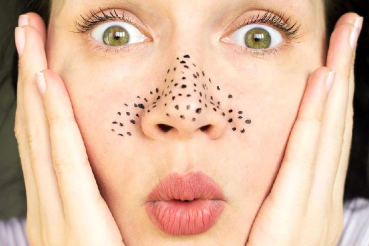 Как бережно заботиться о коже: чего избегать в борьбе с чёрными точками