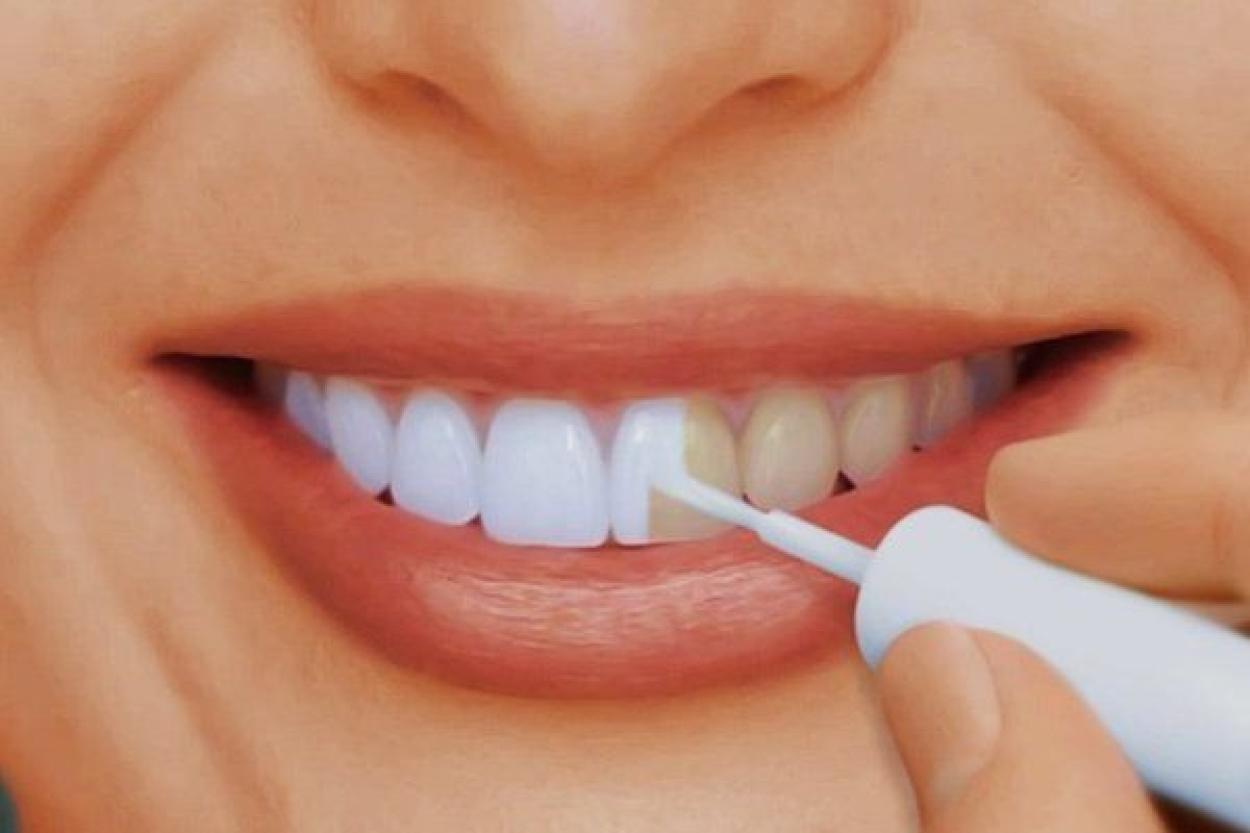 Отбеливание зубов в домашних условиях: за и против