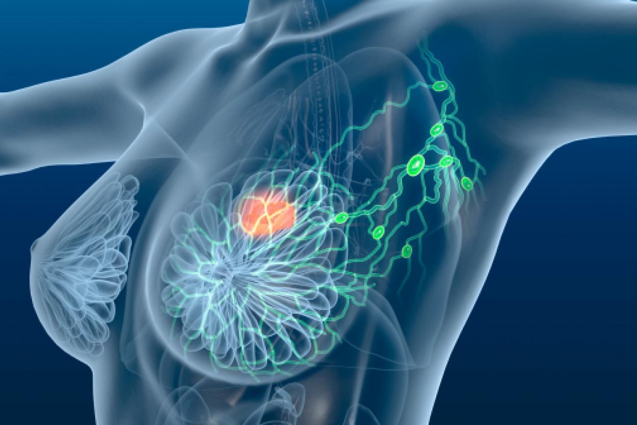 Как повседневные привычки влияют на риск рака молочной железы