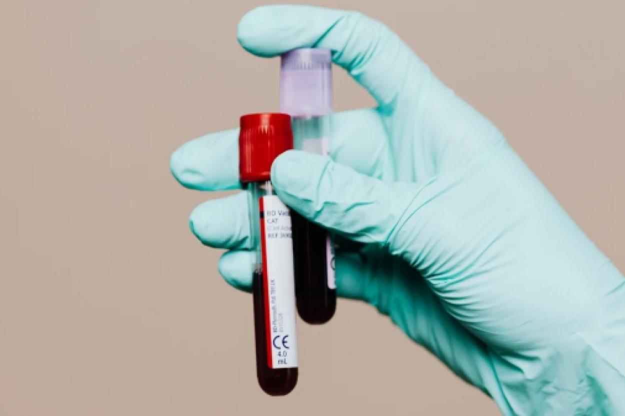 Современный анализ крови: как выявить риск Альцгеймера заранее